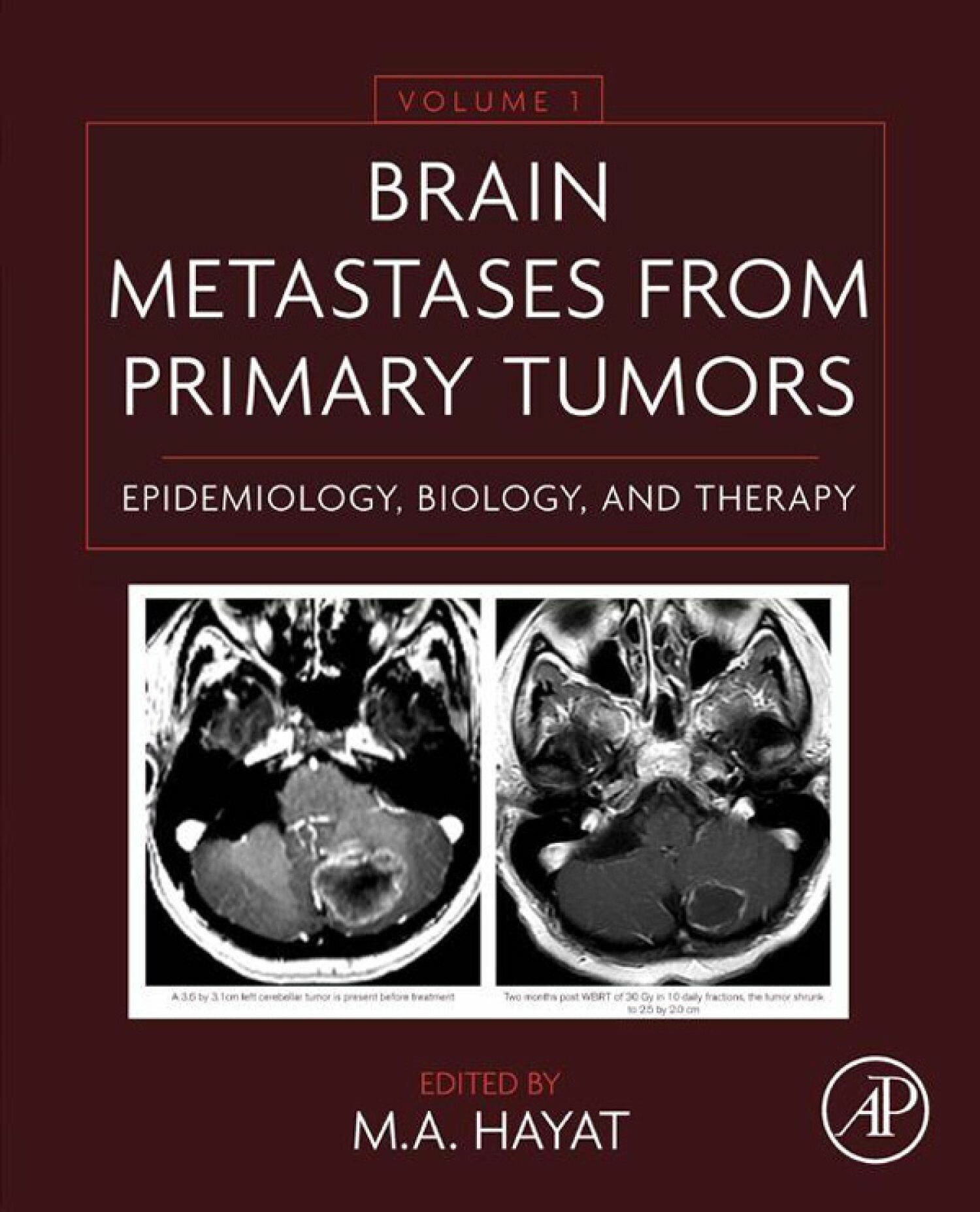 Cover Brain Metastases from Primary Tumors Volume 1