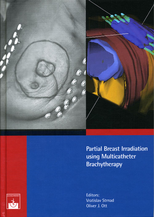 Partial Breast Irradiation using Multicatheter Brachytherapy
