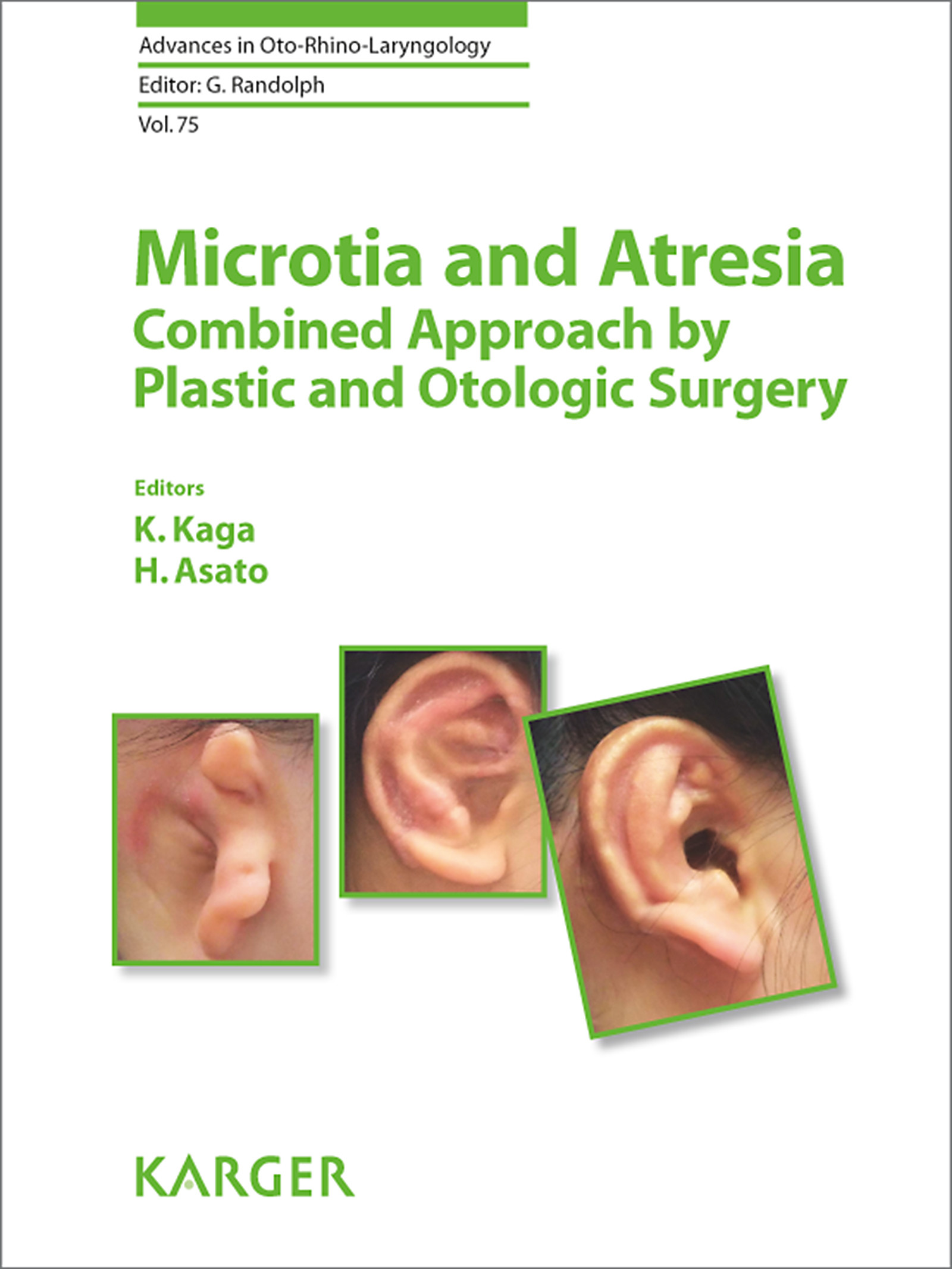 Cover Microtia and Atresia - Combined Approach by Plastic and Otologic Surgery