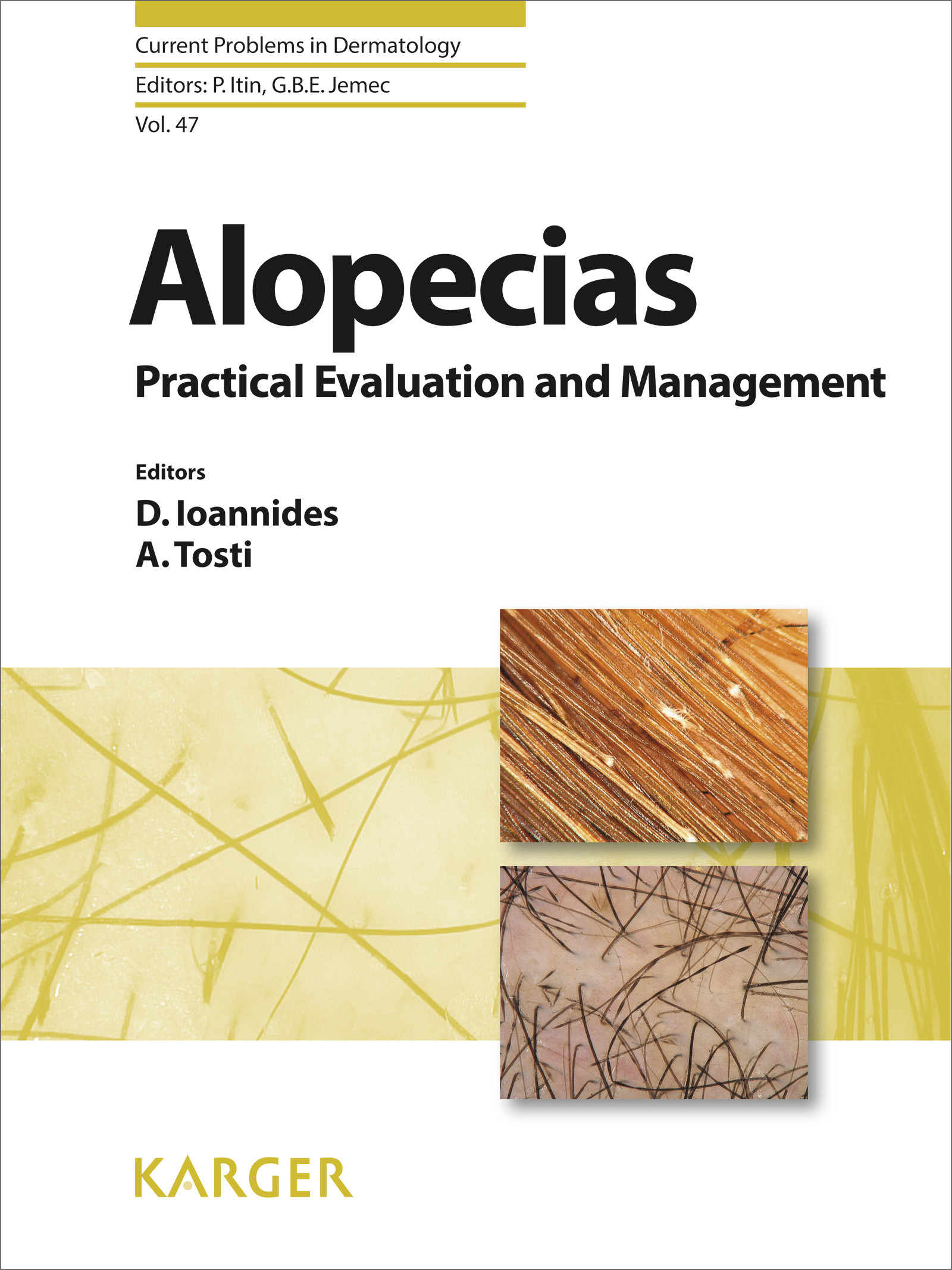 Cover Alopecias - Practical Evaluation and Management