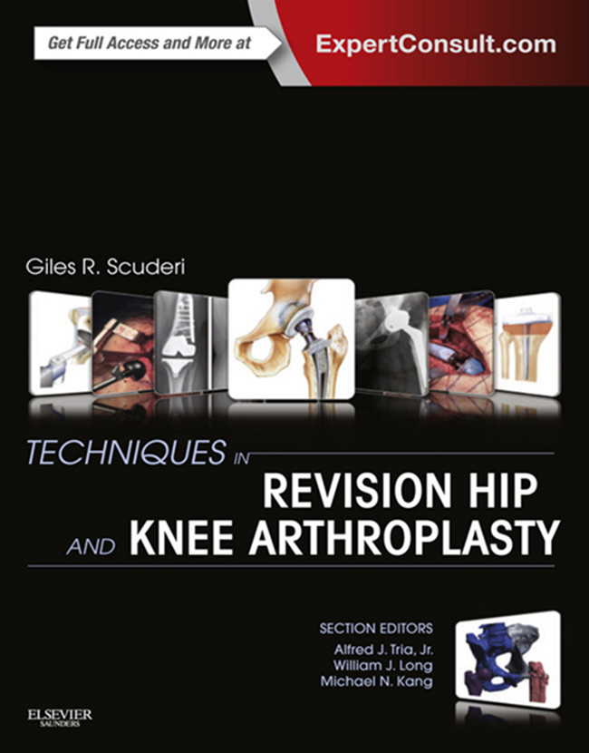 Cover Techniques in Revision Hip and Knee Arthroplasty E-Book