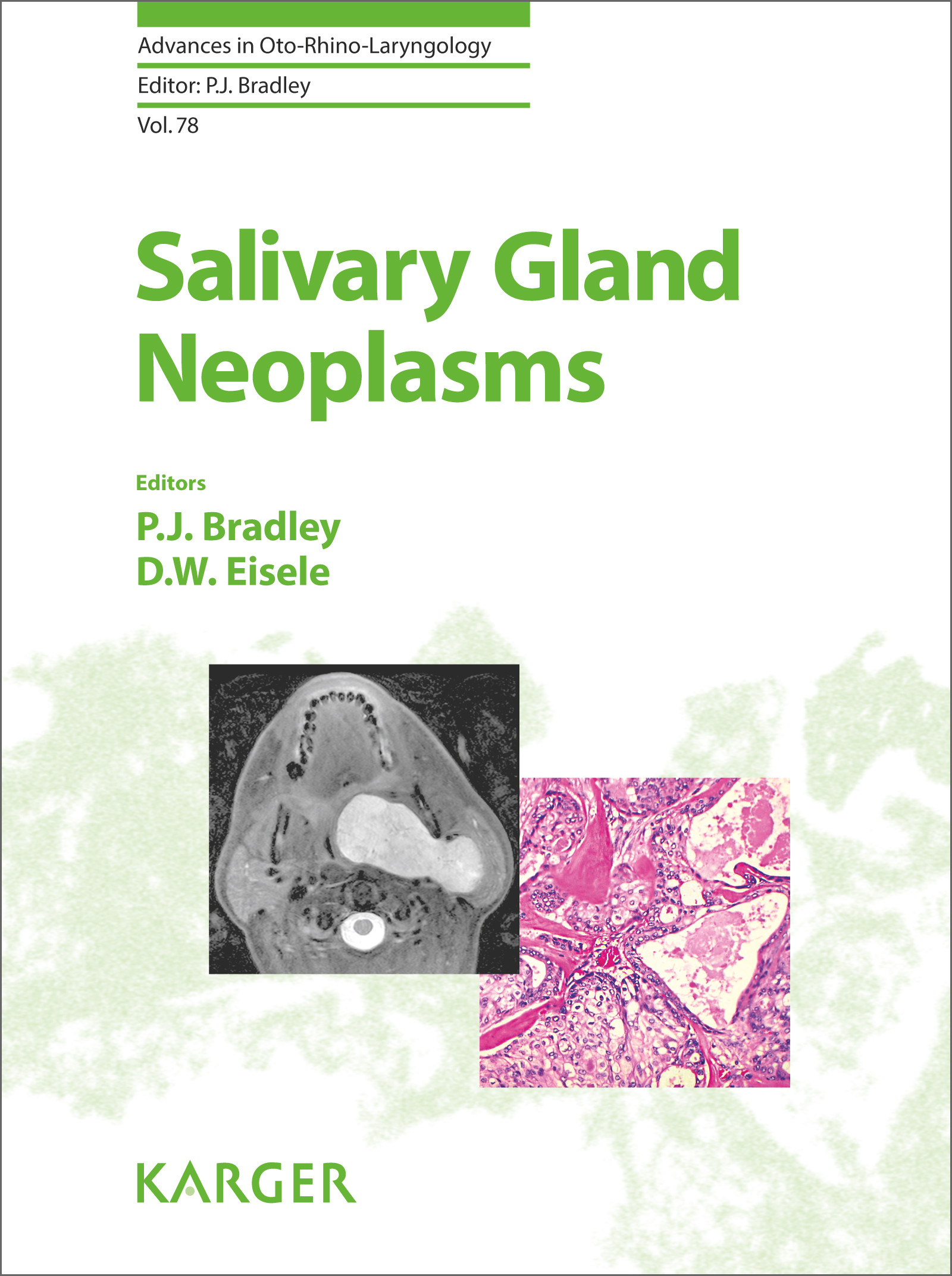 Cover Salivary Gland Neoplasms
