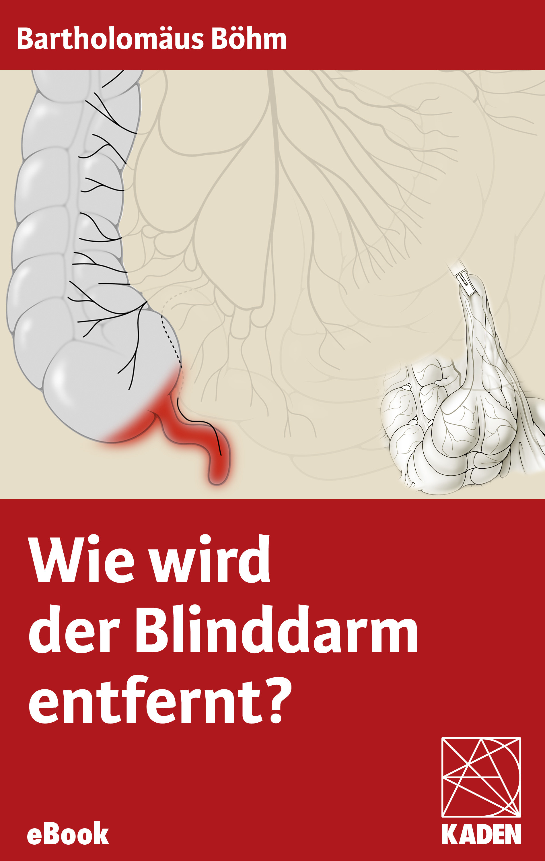 Wie wird der Blinddarm entfernt?