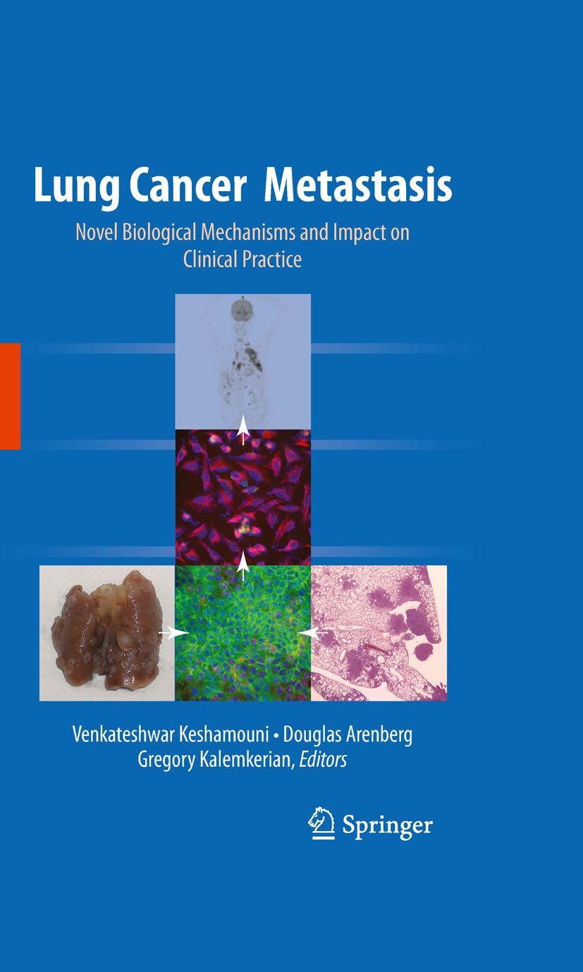 Cover Lung Cancer Metastasis