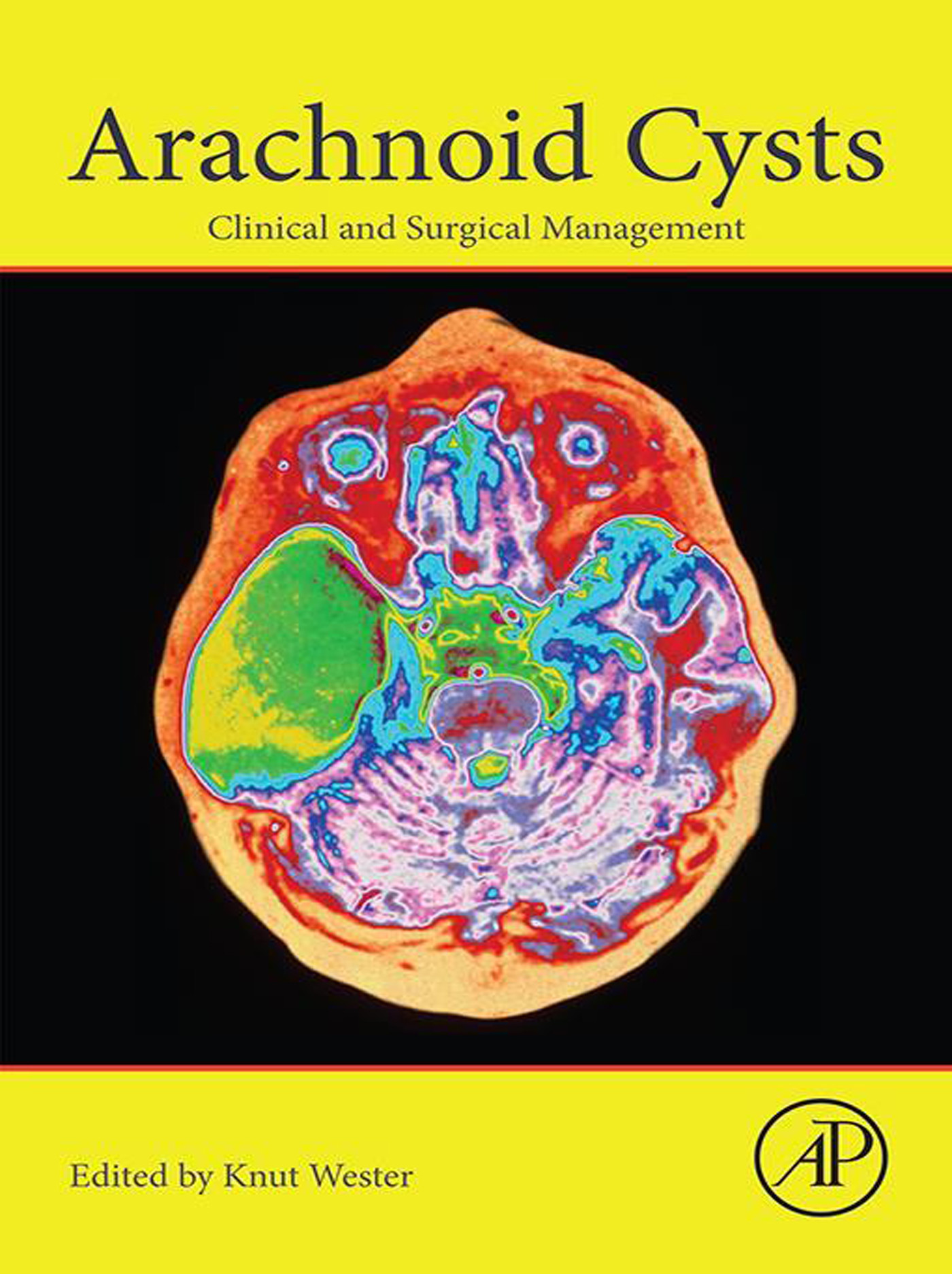 Arachnoid Cysts