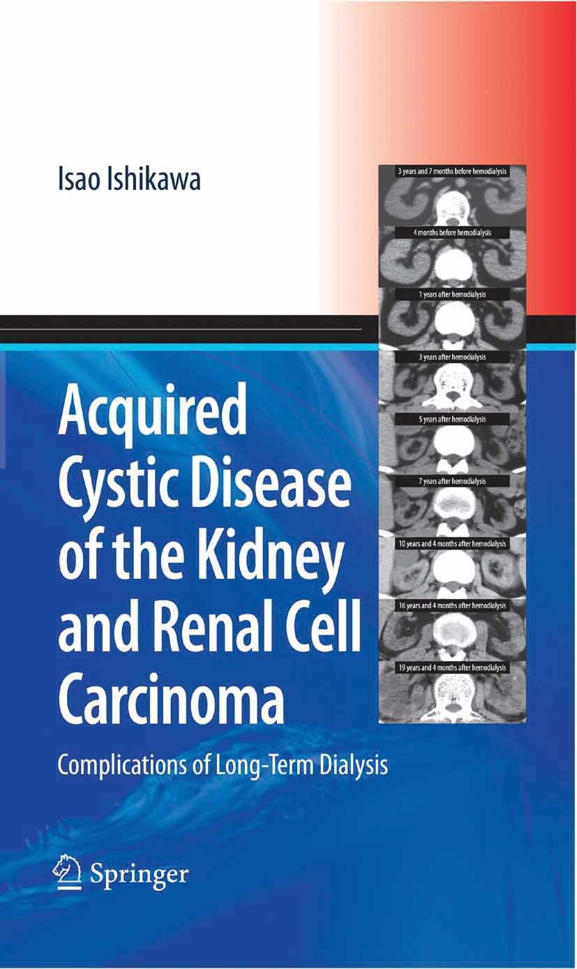 Acquired Cystic Disease of the Kidney and Renal Cell Carcinoma