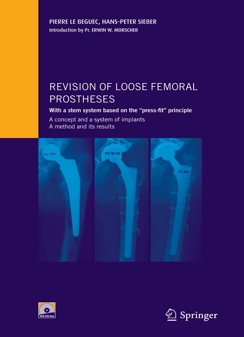 Cover Revision of loose femoral prostheses with a stem system based on the 'press-fit' principle