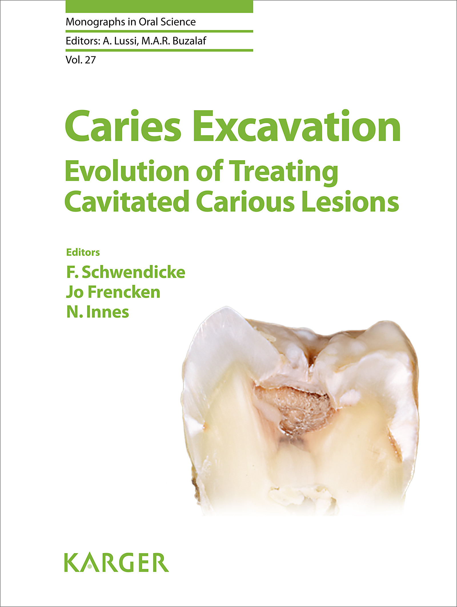 Caries Excavation Evolution of Treating Cavitated Carious Lesions EBook