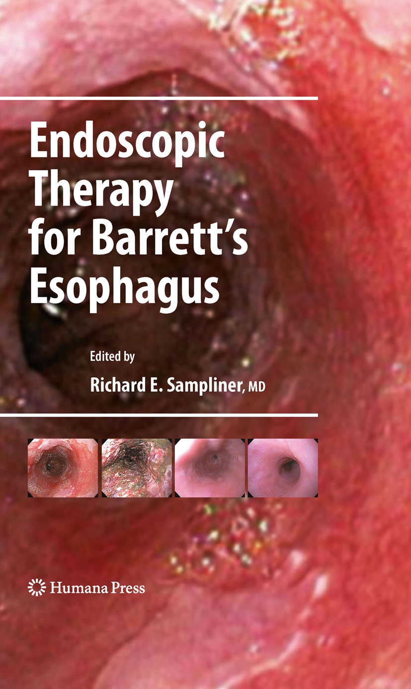 Cover Endoscopic Therapy for Barrett's Esophagus