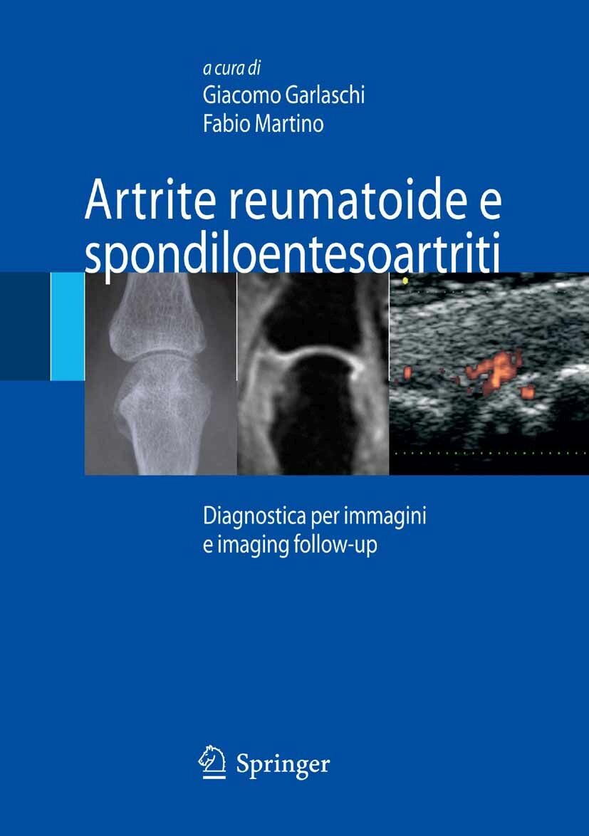 Artrite reumatoide e spondiloentesoartriti