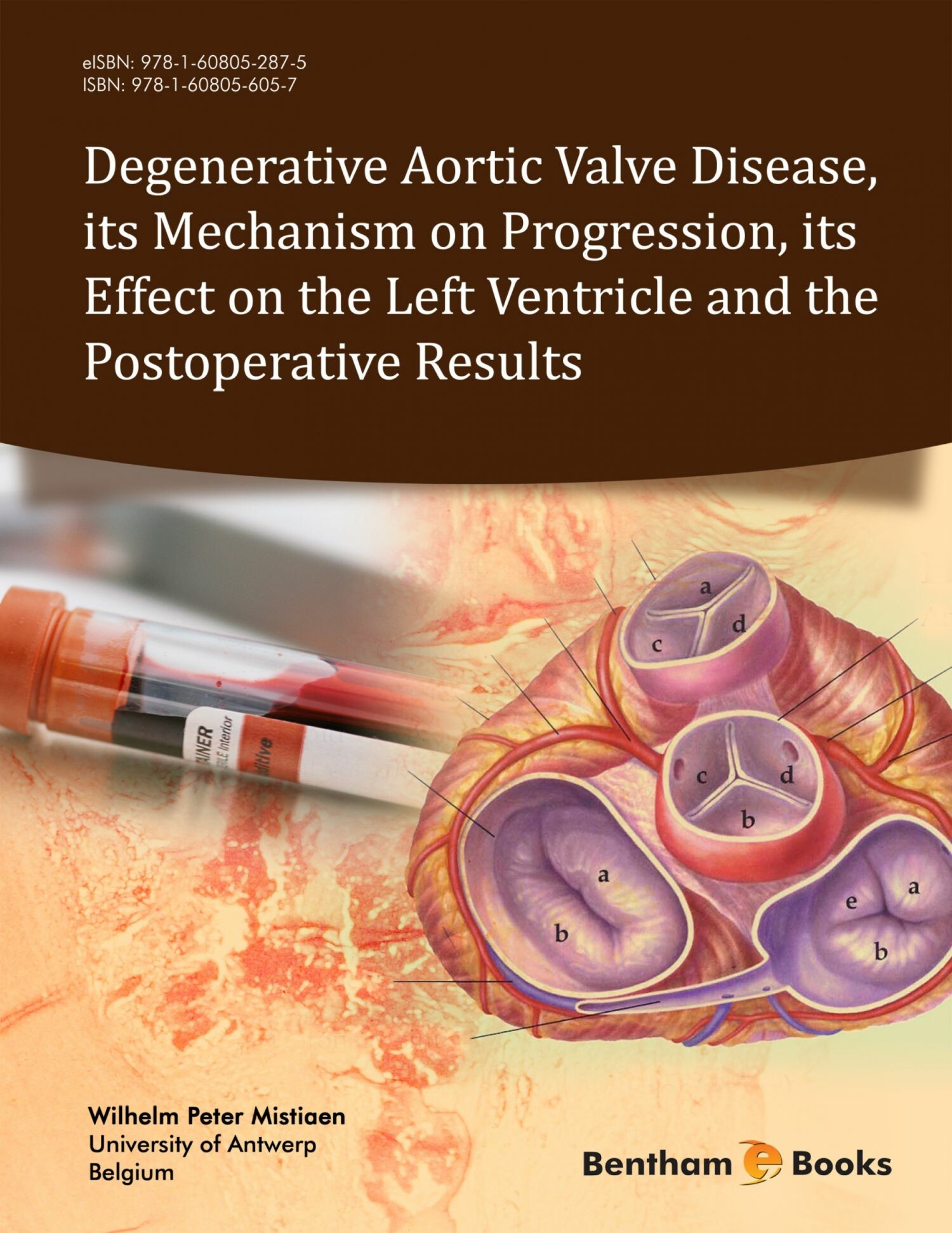 Cover Degenerative Aortic Valve Disease, its Mechanism on Progression, its Effect on the Left Ventricle and the Postoperative Results
