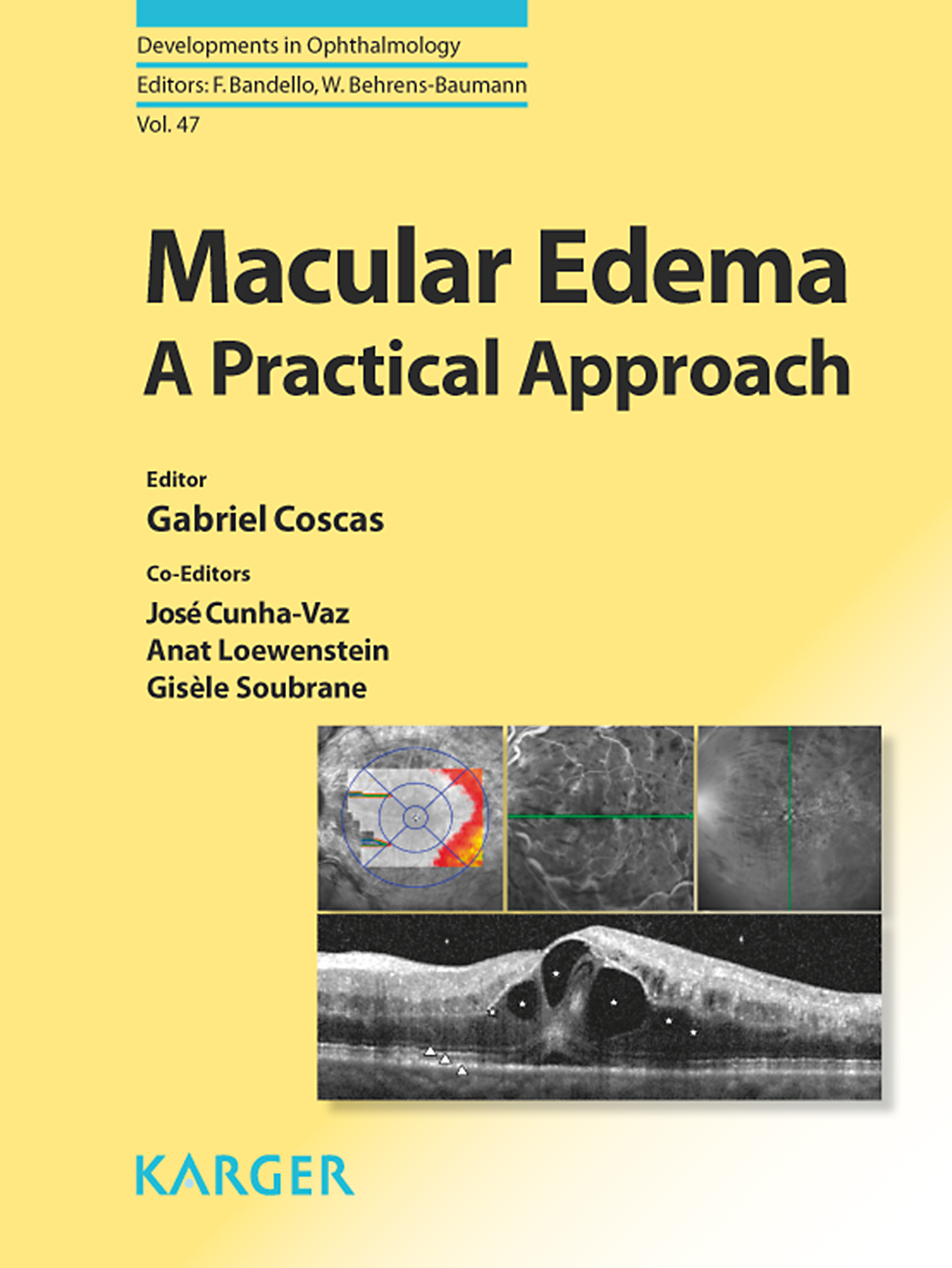Cover Macular Edema