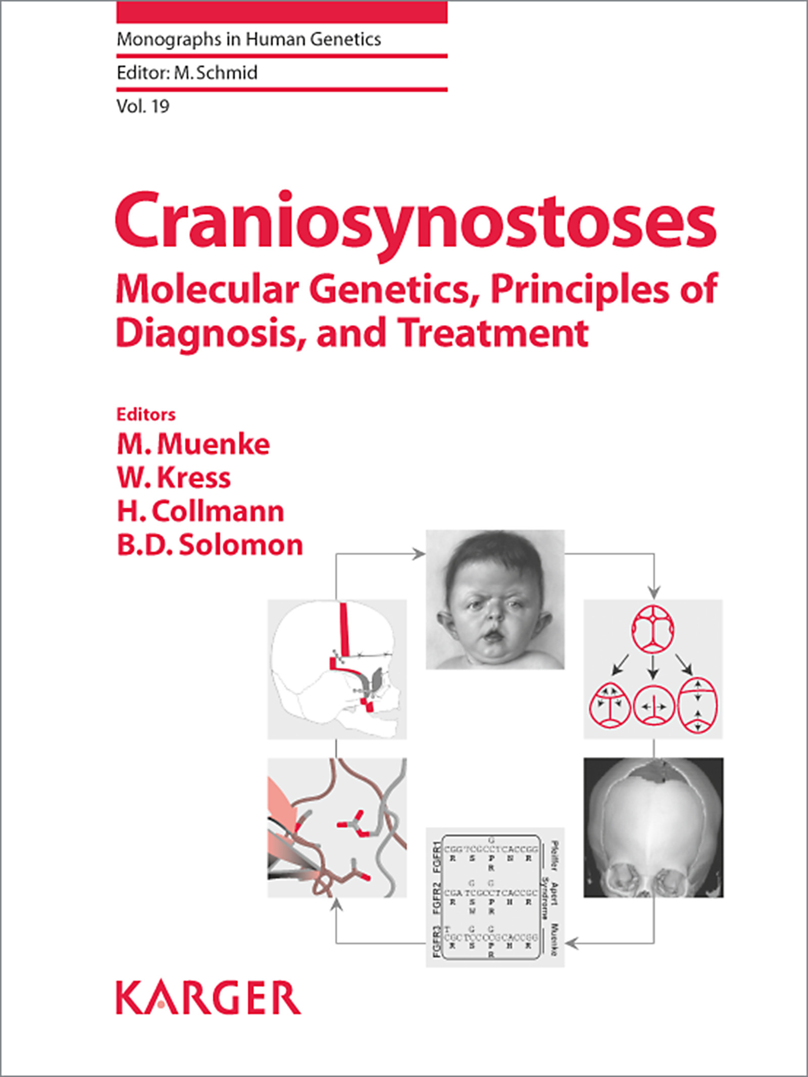 Cover Craniosynostoses