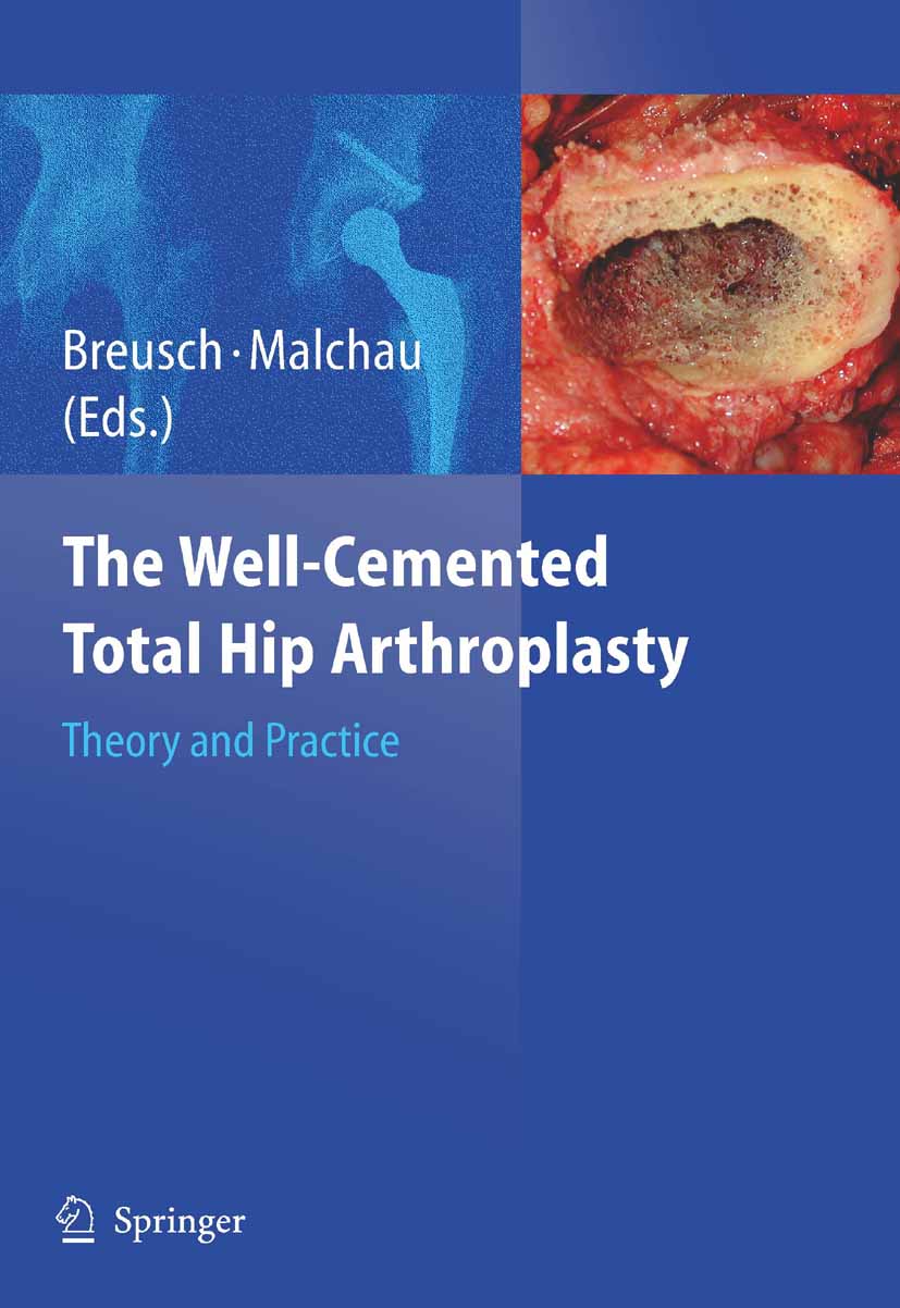 Cover The Well-Cemented Total Hip Arthroplasty
