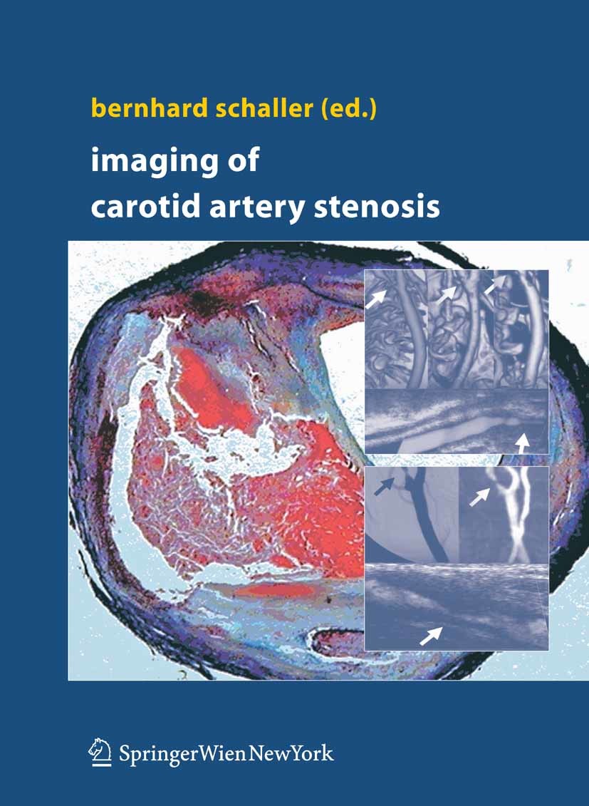 Imaging of Carotid Artery Stenosis