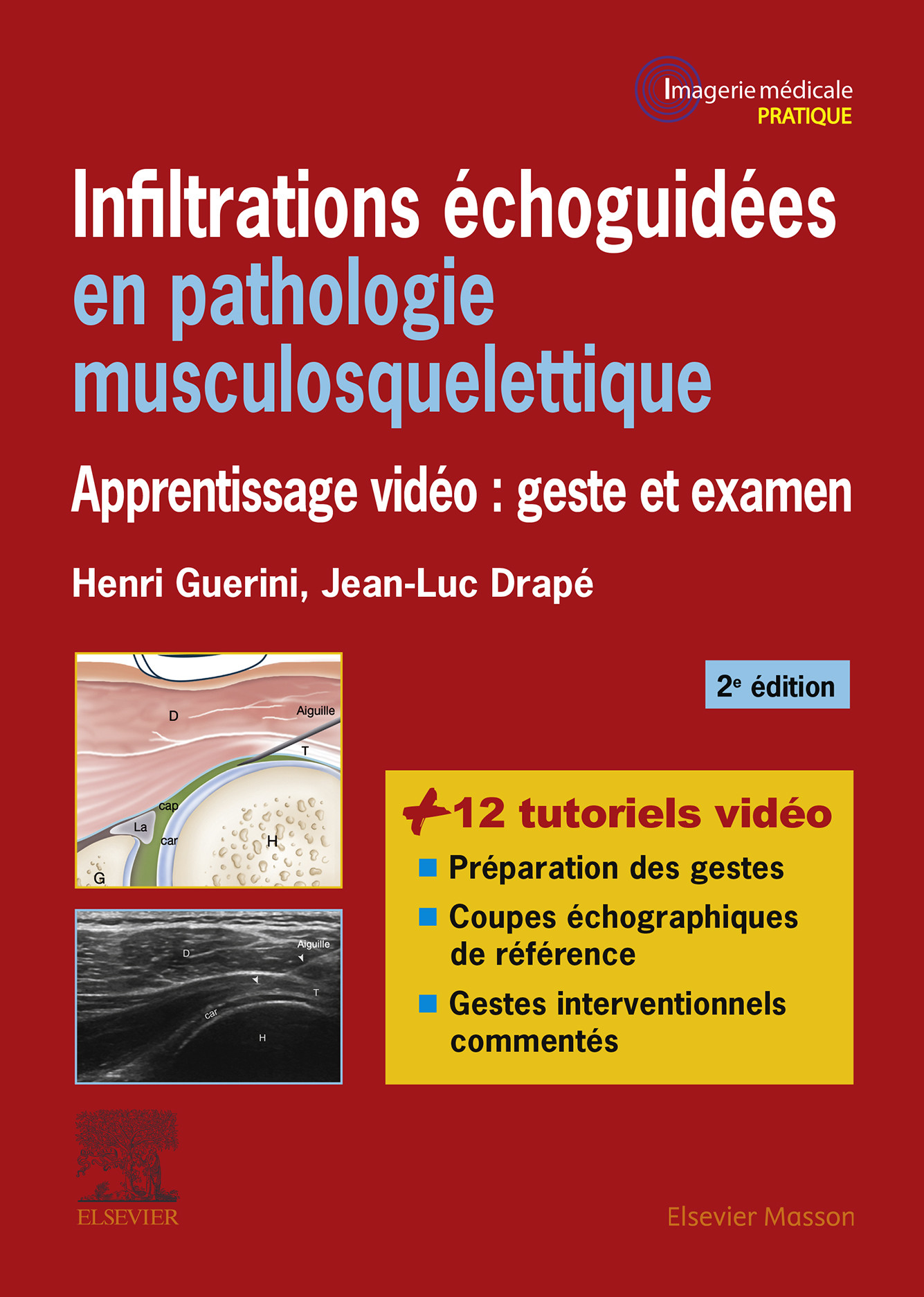 Cover Infiltrations échoguidées en pathologie musculosquelettique
