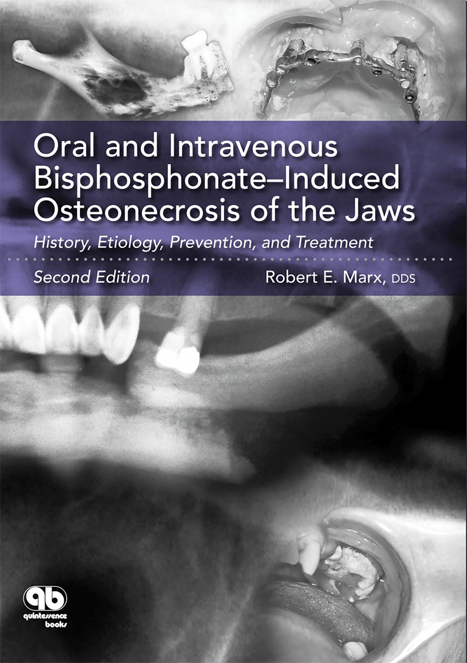 Cover Oral and Intravenous Bisphosphonate-Induced Osteonecrosis of the Jaws