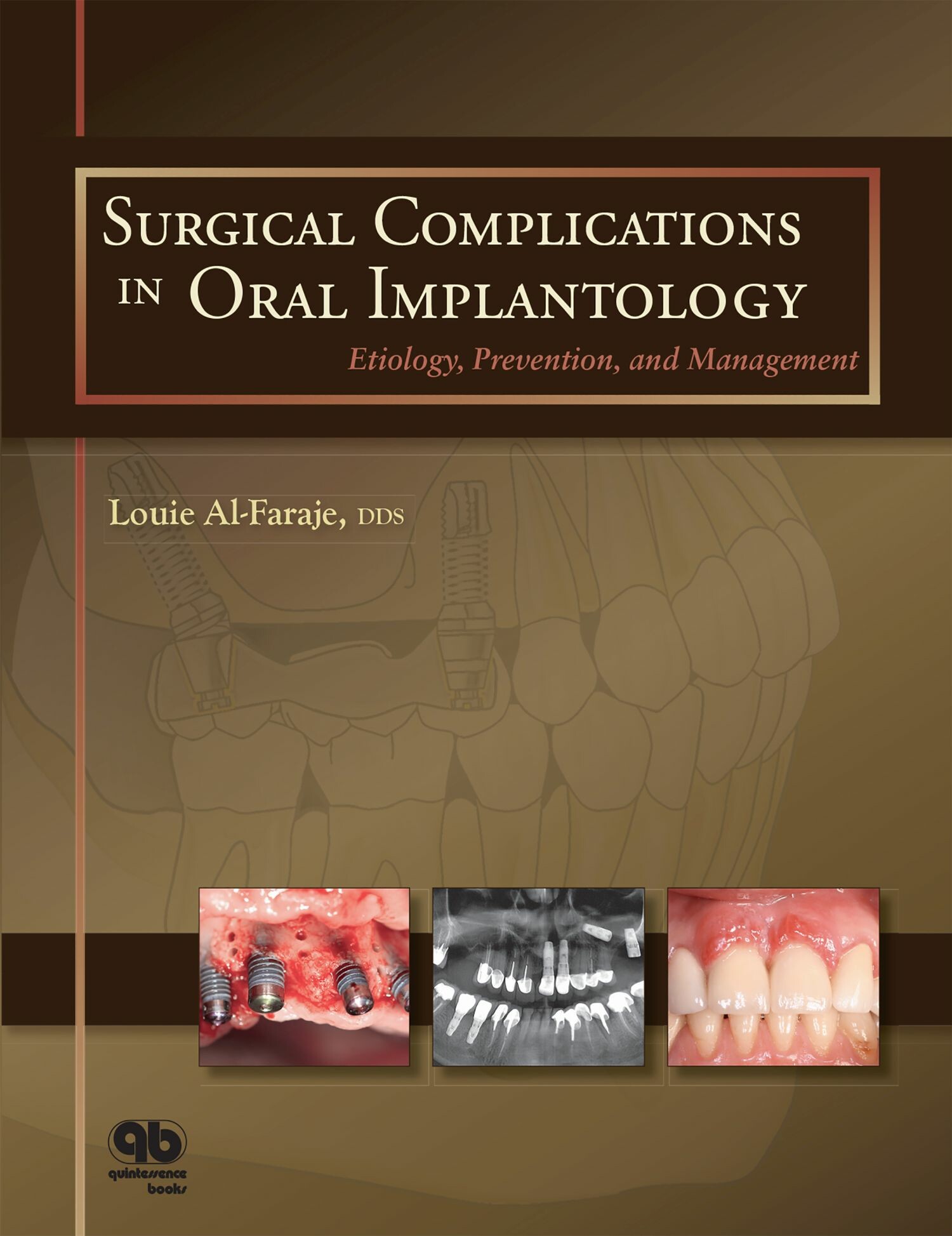 Cover Surgical Complications in Oral Implantology