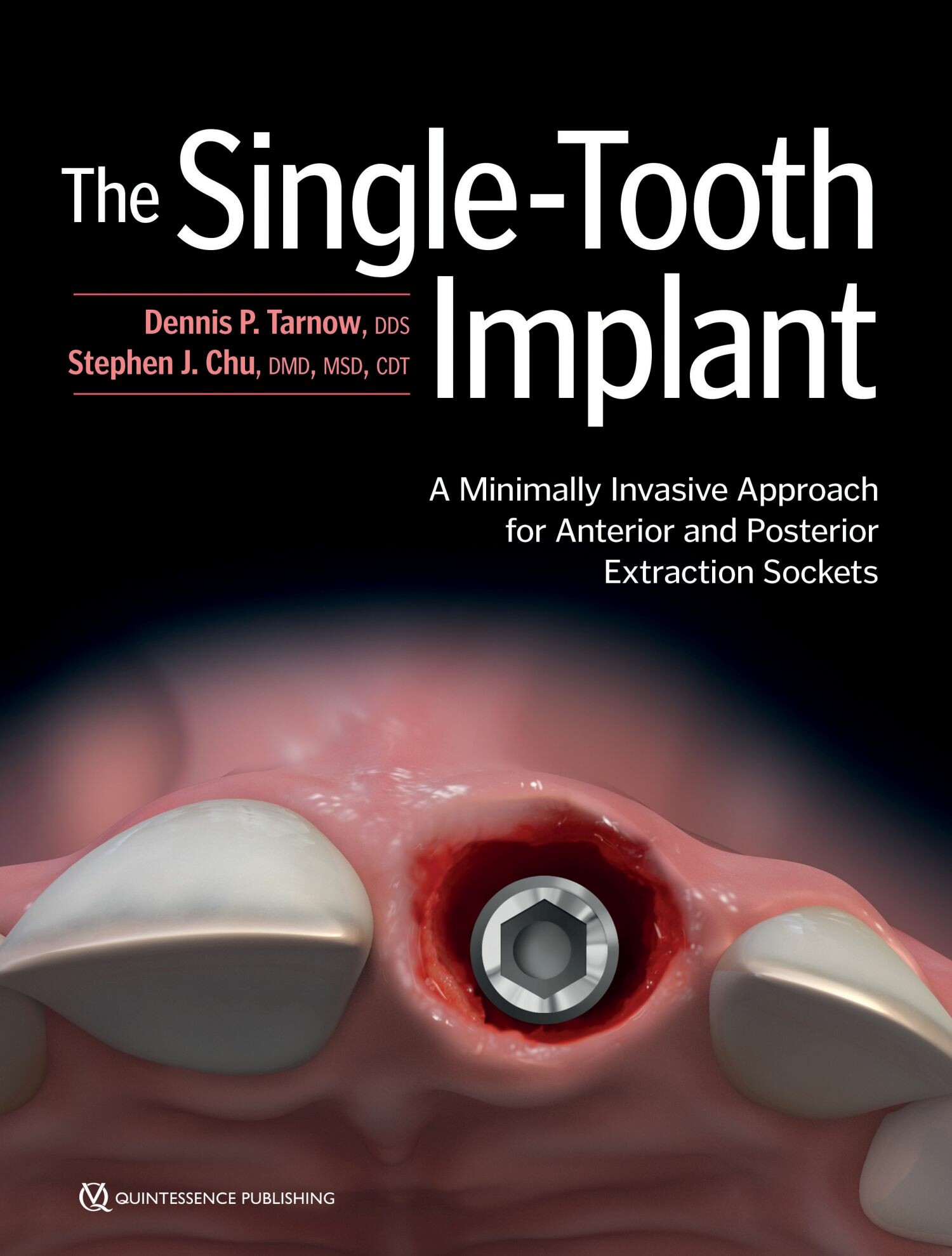 Cover The Single-Tooth Implant: