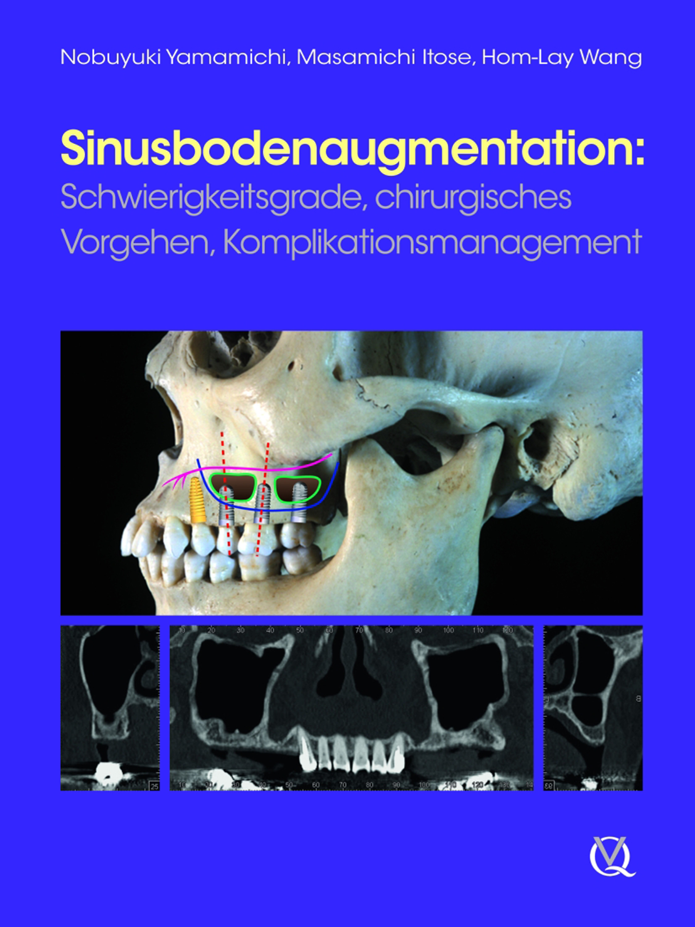 Cover Sinusbodenaugmentation