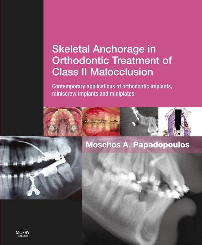 Cover Skeletal Anchorage in Orthodontic Treatment of Class II Malocclusion E-Book