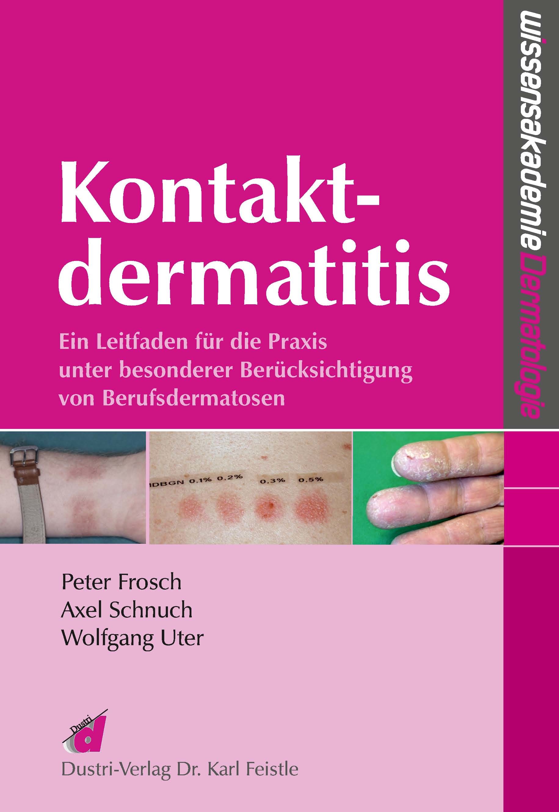 Kontaktdermatitis