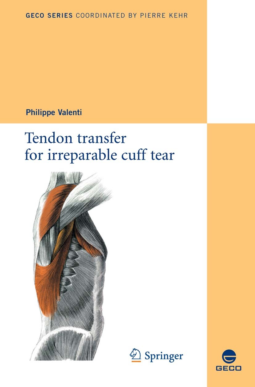 Cover Tendon transfer for irreparable cuff tear