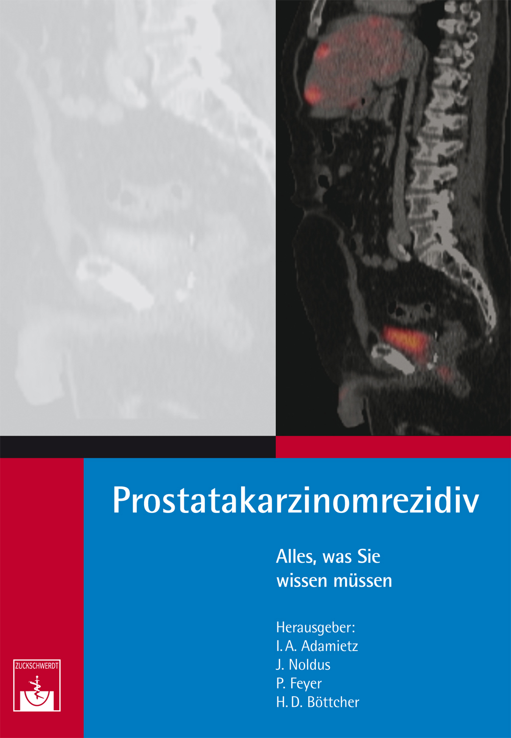 Prostatakarzinomrezidiv