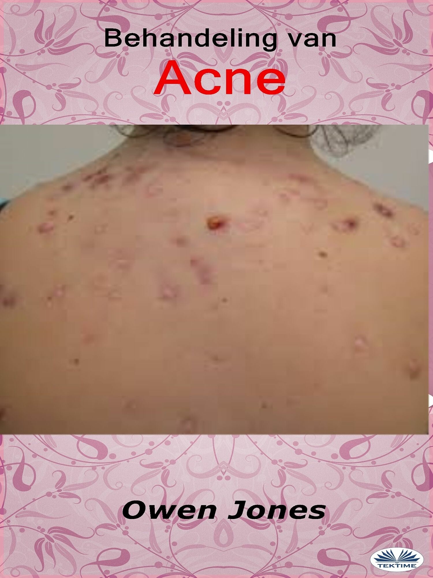Cover Behandeling Van Acne