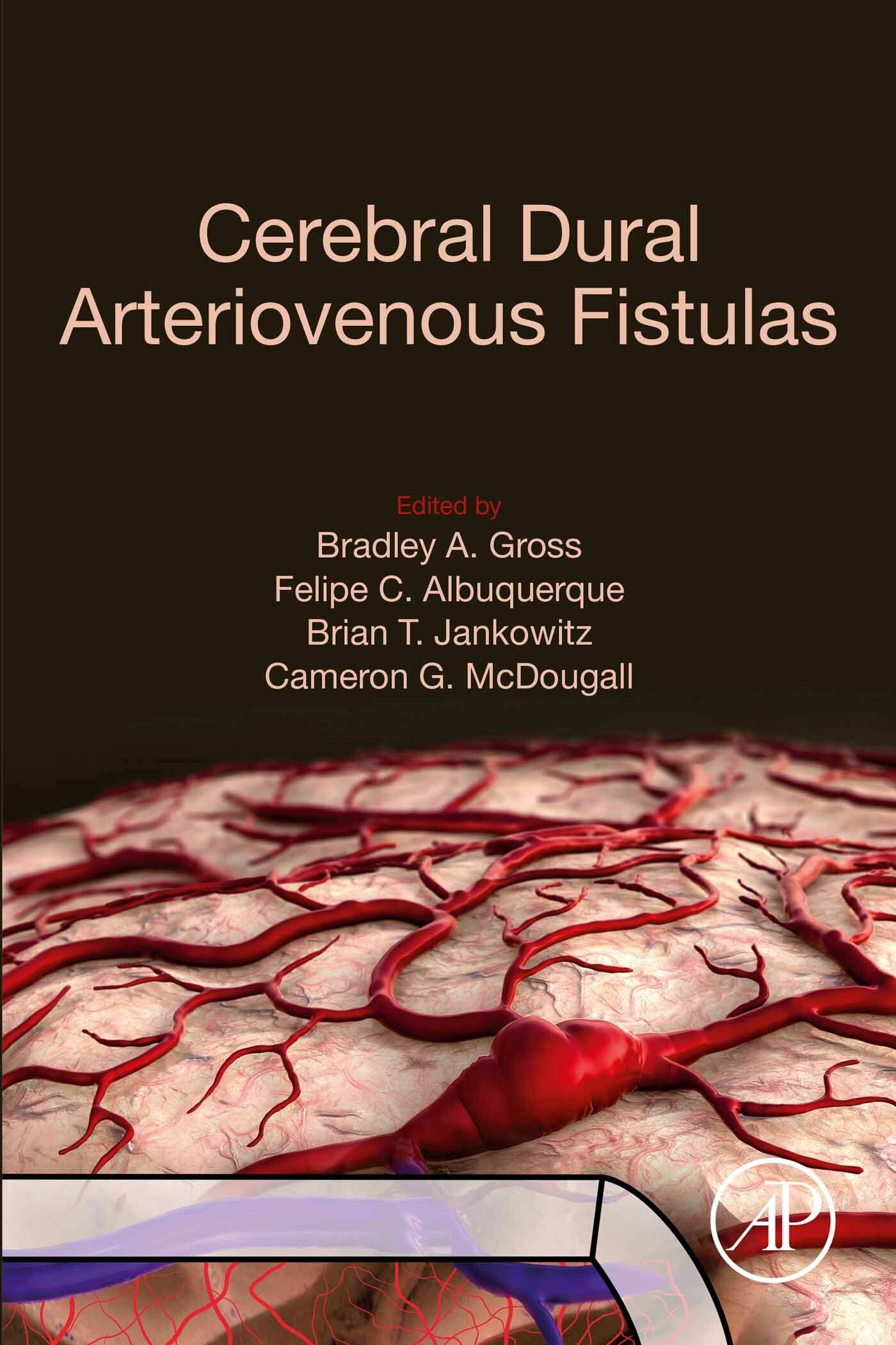 Cover Cerebral Dural Arteriovenous Fistulas