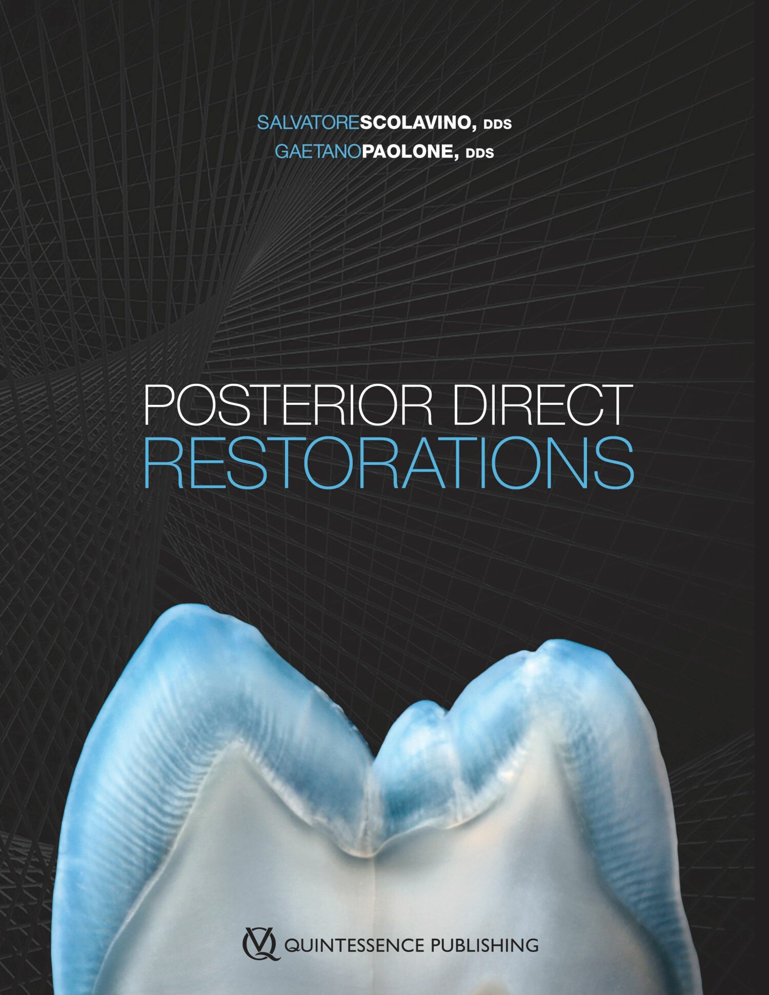 Cover Posterior Direct Restorations