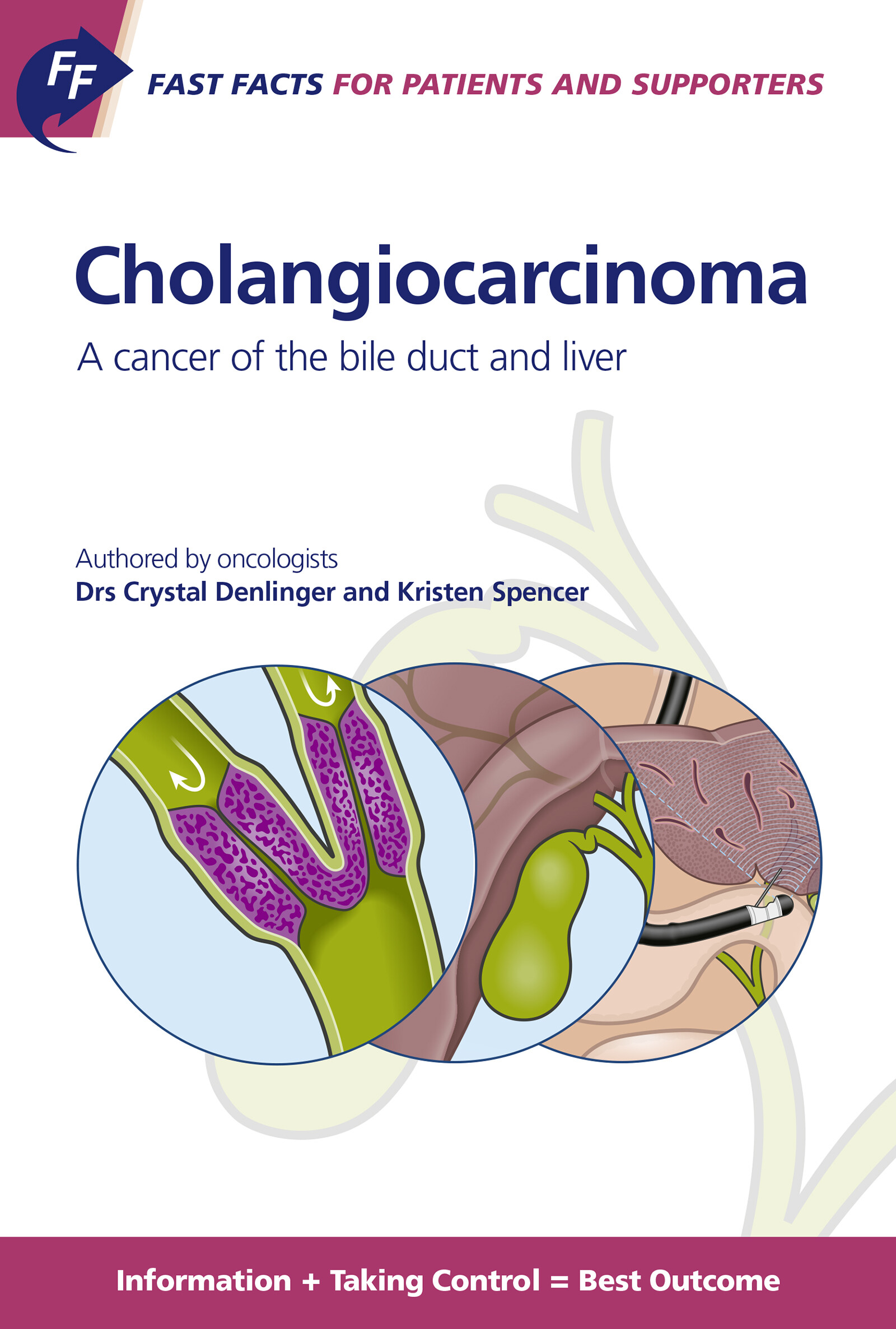 Cover Fast Facts: Cholangiocarcinoma for Patients and their Supporters