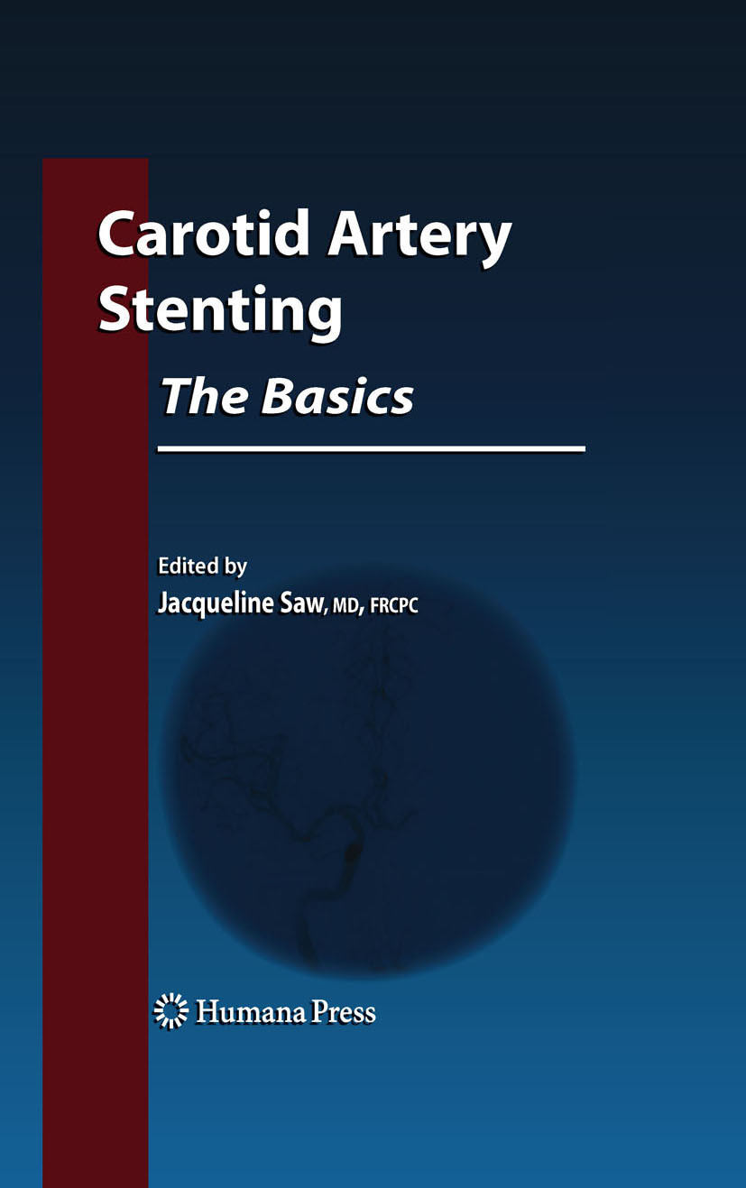 Cover Carotid Artery Stenting: The Basics