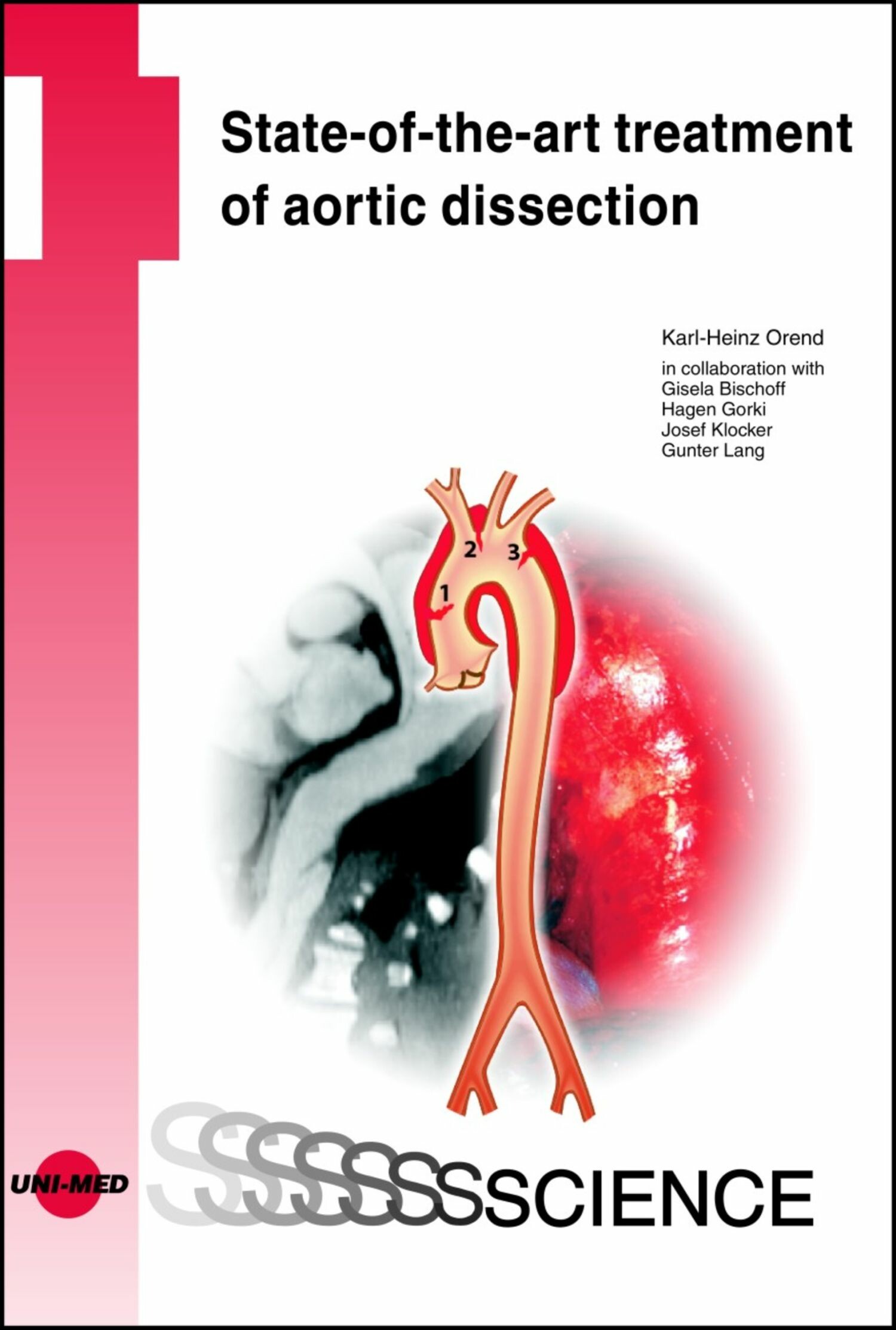 Cover State-of-the-art treatment of aortic dissection
