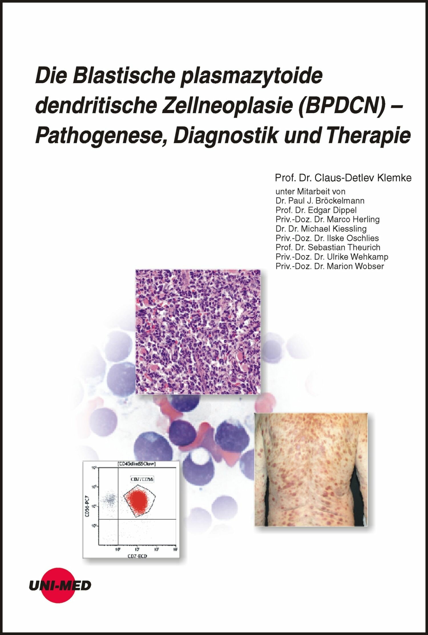 Cover Die Blastische plasmazytoide dendritische Zellneoplasie (BPDCN) - Pathogenese, Diagnostik und Therapie