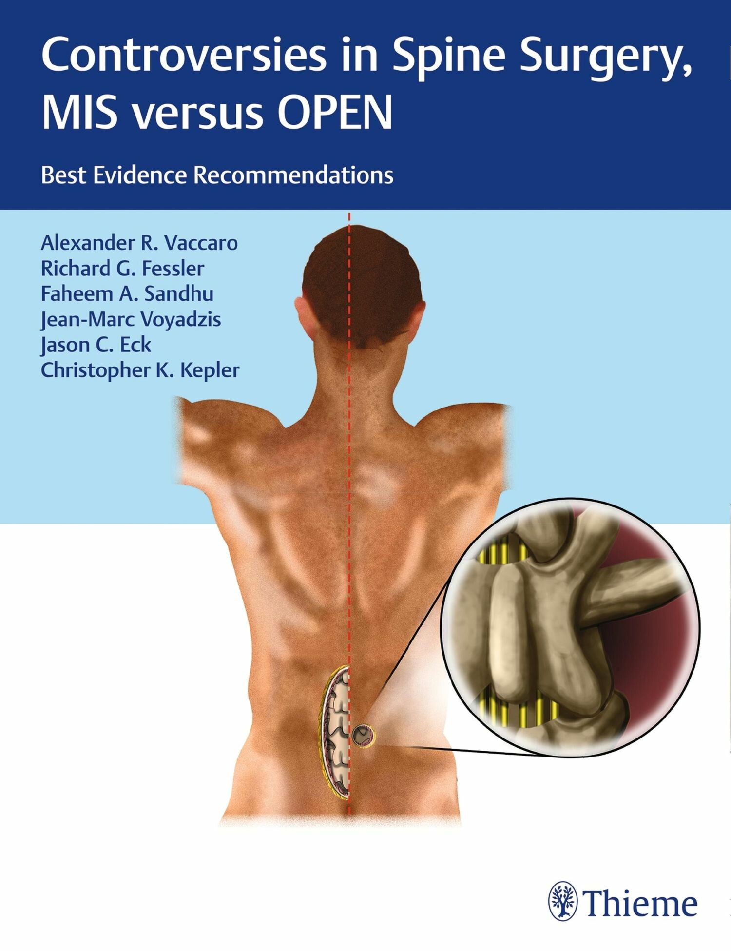 Cover Controversies in Spine Surgery, MIS versus OPEN