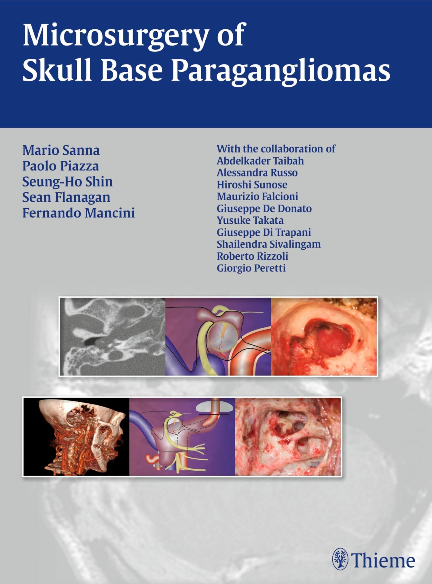 Cover Microsurgery of Skull Base Paragangliomas