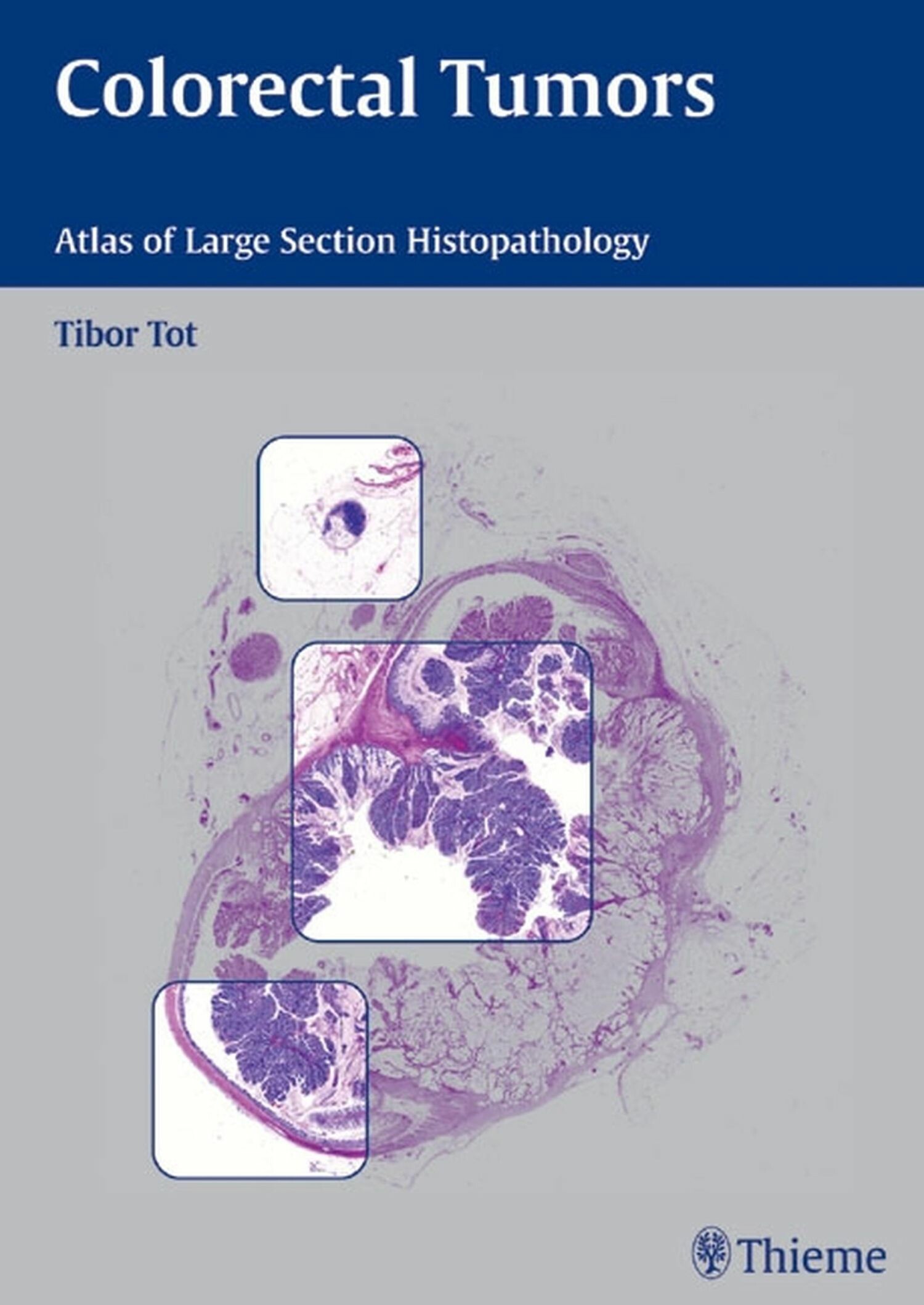 Cover Colorectal Tumors
