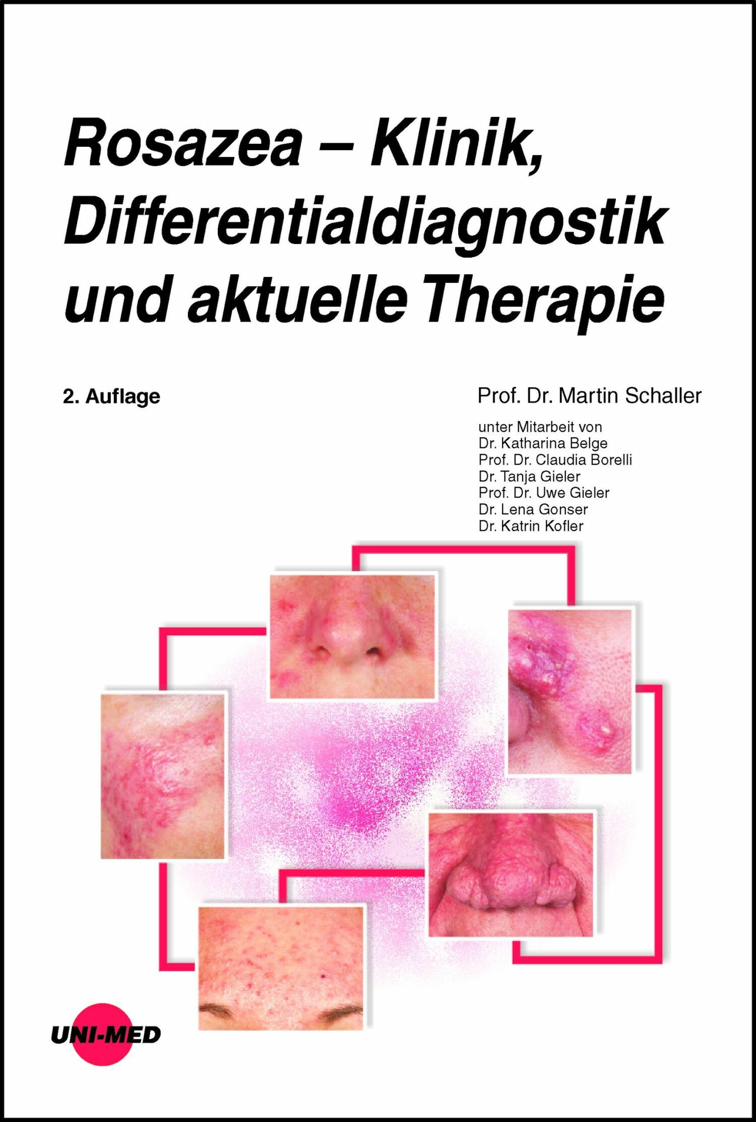 Rosazea - Klinik, Differentialdiagnostik und aktuelle Therapie