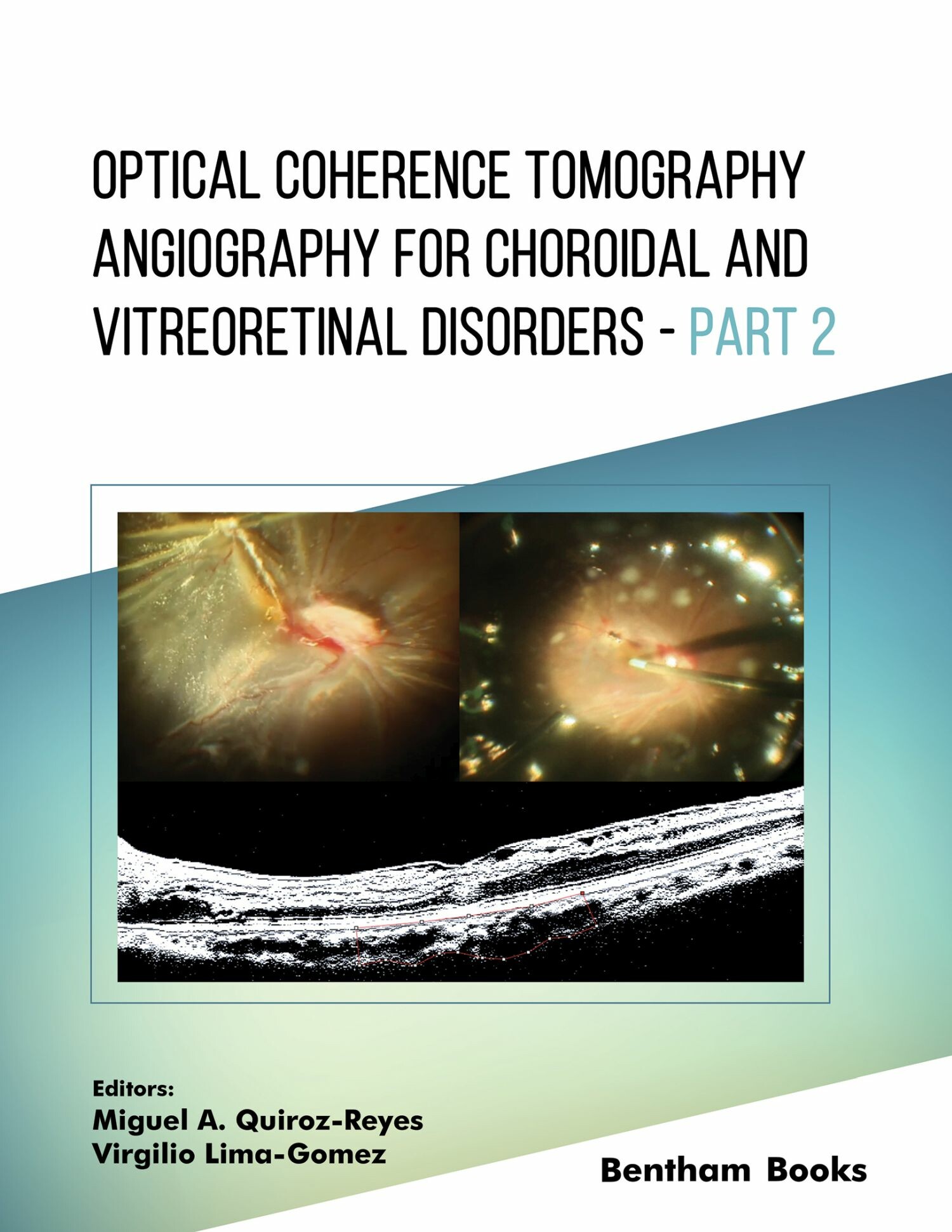Cover Optical Coherence Tomography Angiography for Choroidal and Vitreoretinal Disorders - Part 2