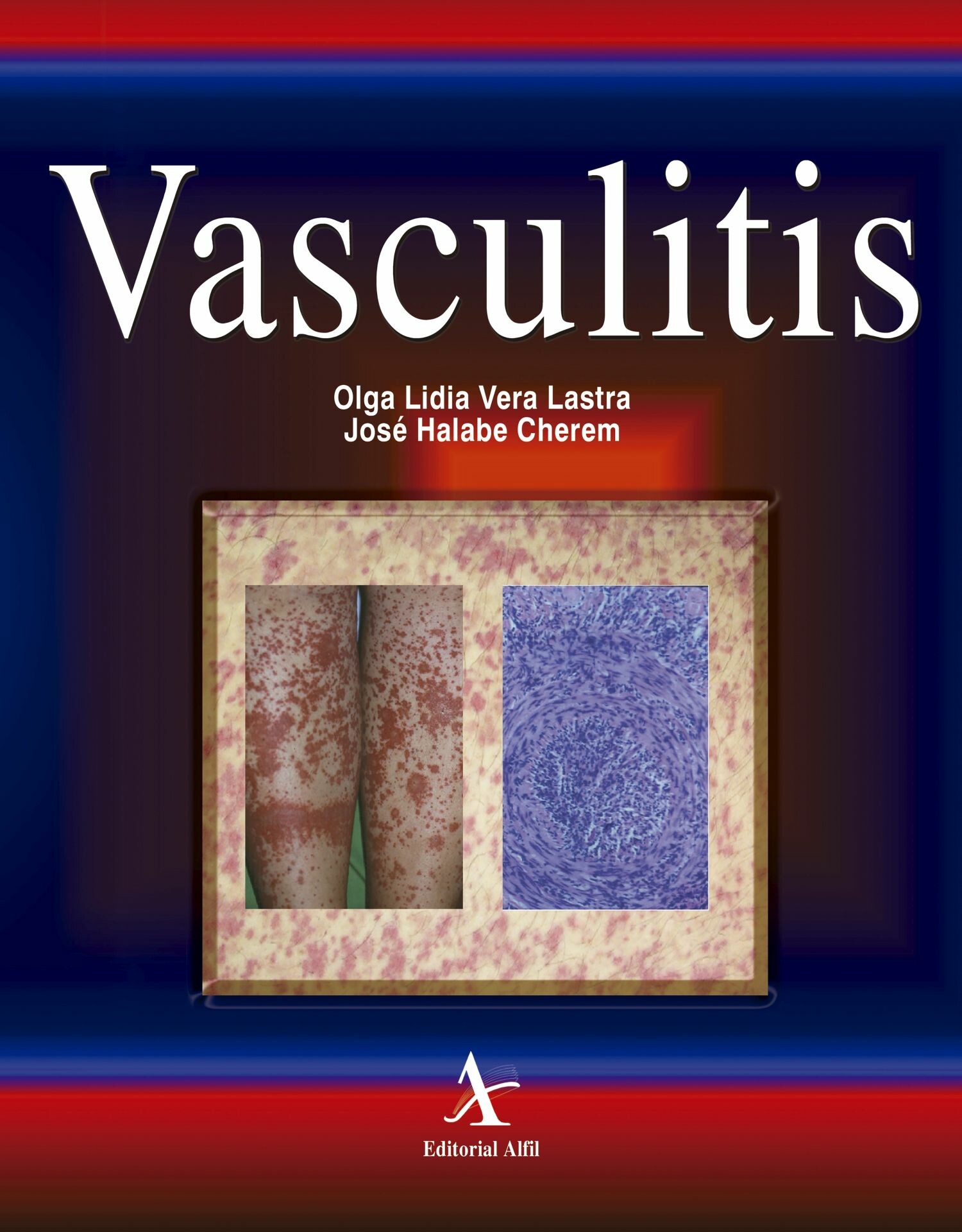 Cover Vasculitis
