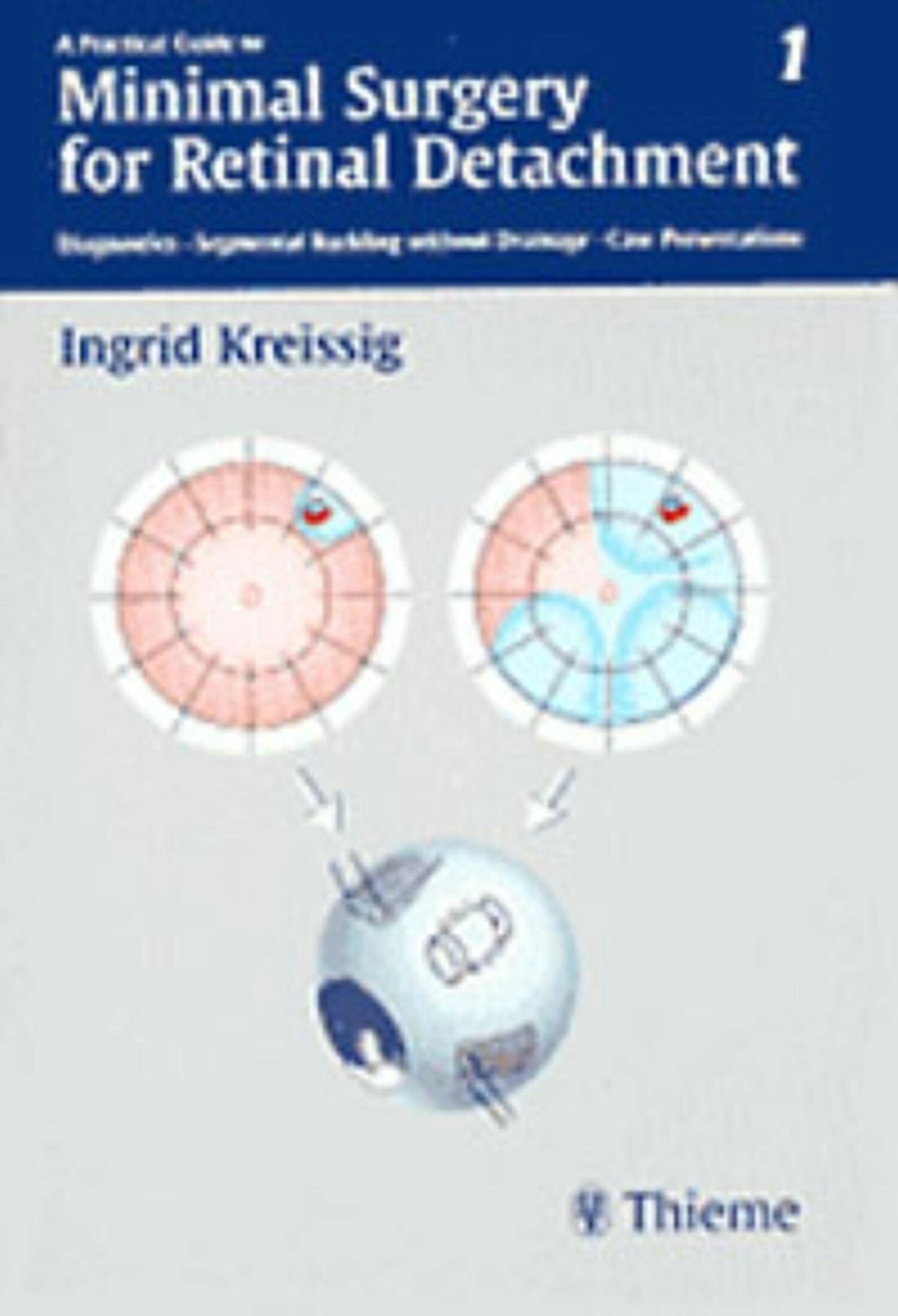Cover A Practical Guide to Minimal Surgery for Retinal Detachment, Vol. 1