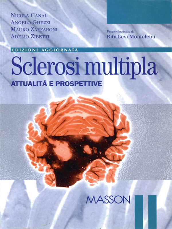 Sclerosi multipla