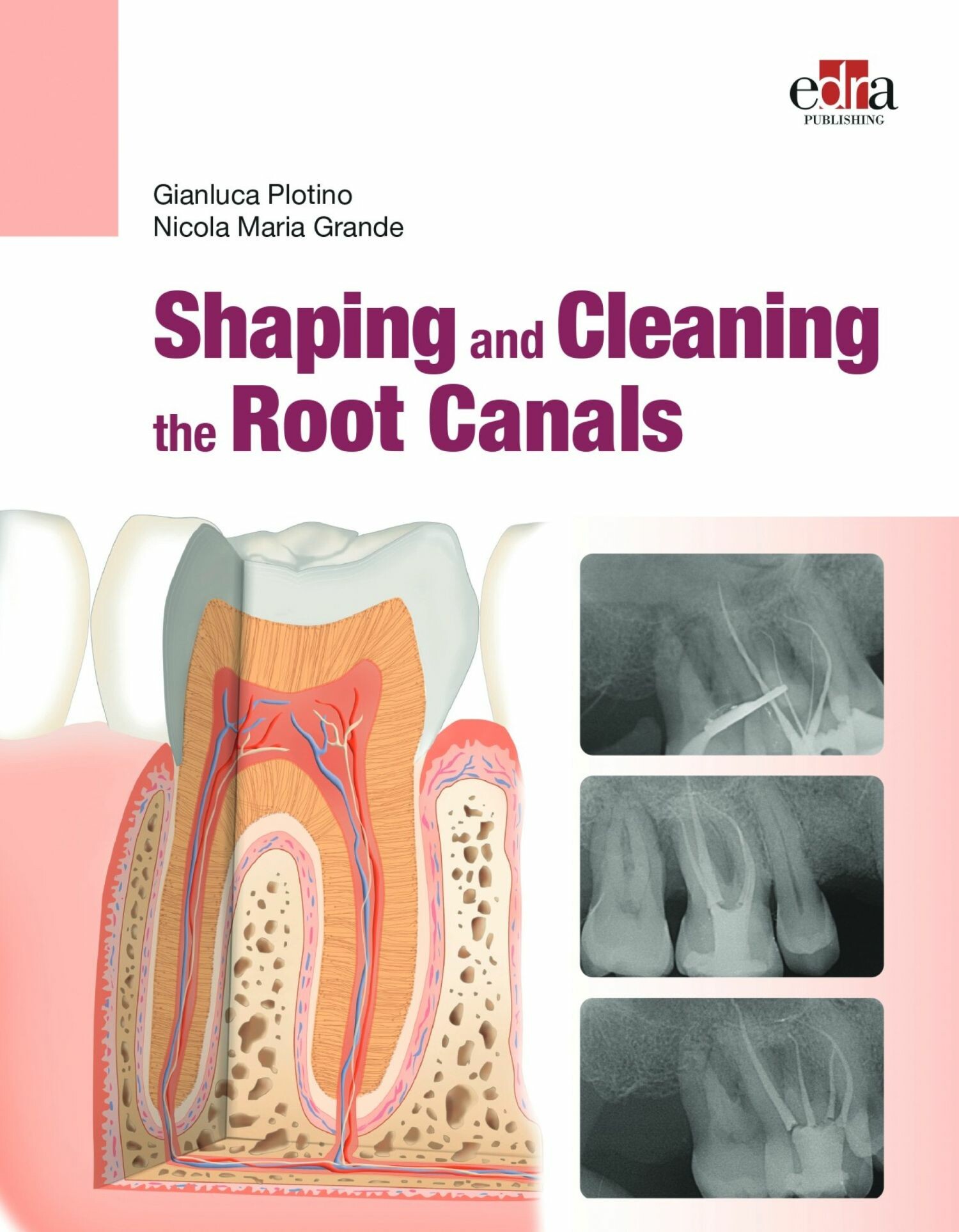 Cover Shaping and  Cleaning the Root Canals