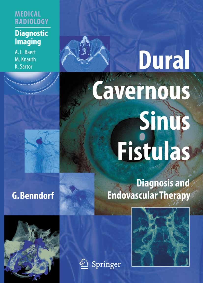 Cover Dural Cavernous Sinus Fistulas