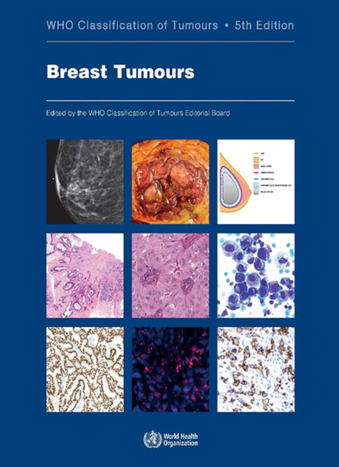 WHO Classification of Tumours: Breast Tumours