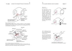 Endometriose - Die verkannte Frauenkrankheit