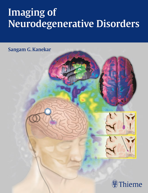 Imaging of Neurodegenerative Disorders