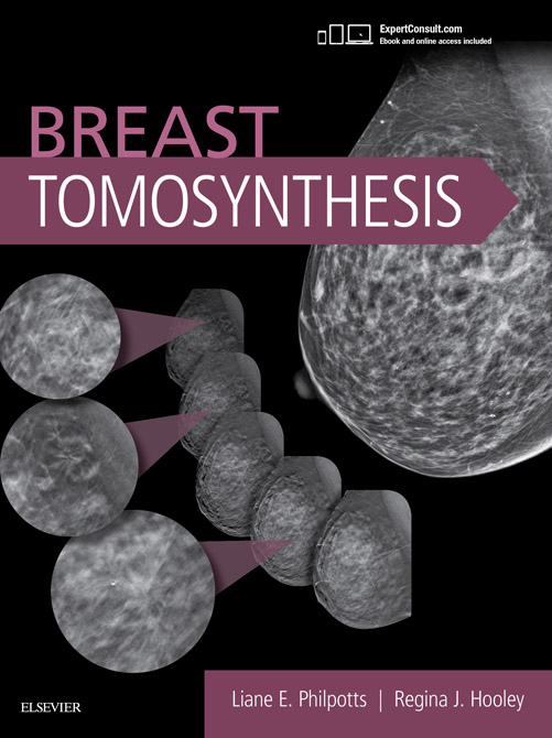 Breast Tomosynthesis