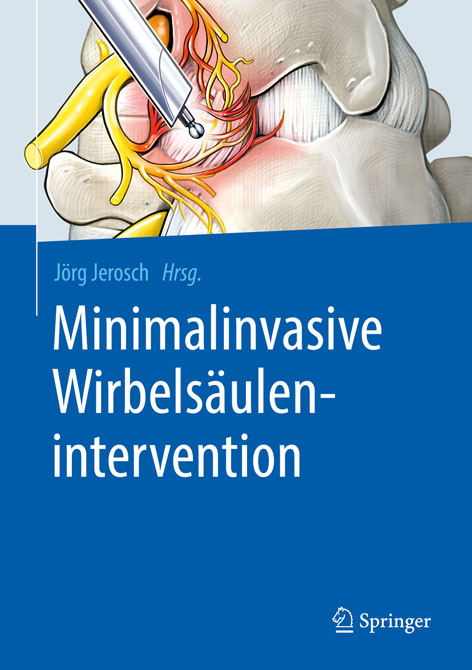 Minimalinvasive Wirbelsäulenintervention